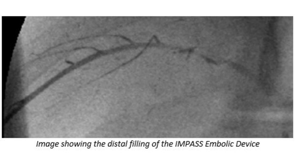 Fluidx Unveils New Embolic for Neurovascular Use - Vimarsana News