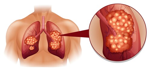 Chinese Medical Journal Article Reveals Gender-Based Differences in Lung Cancer Risk Among Non-Smokers