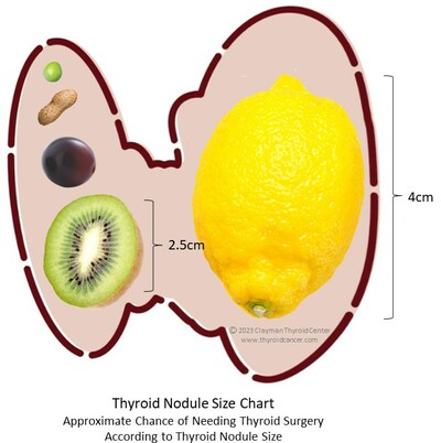 Thyroid nodule size chart demonstrates relative size and the effects large nodules have on the thyroid gland. Enlarged left thyroid lobe shown would lead to symptoms like difficulty breathing and swallowing and would require surgical treatment.