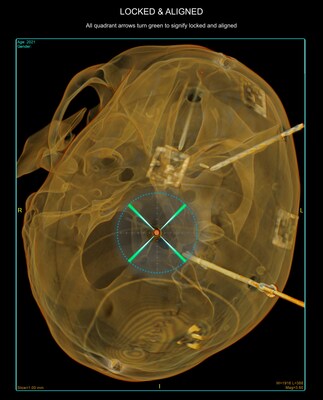 Skull Phantom with 0.5mm targets