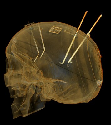 Skull phantom showing instruments after placement with VisAR