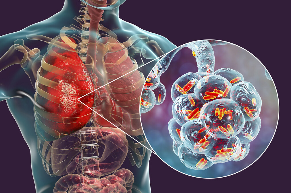 Pritzker Hageman Legionnaires' Disease Lawyers Investigate Legionella Outbreaks Nationwide - Vimarsana News