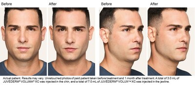JUVÉDERM® VOLUX™ XC actual patient before and after treatment photos.