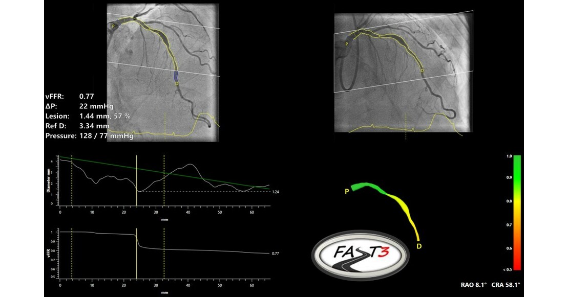Pie Medical Imaging announces 500th patient in the FAST III clinical trial