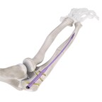 Conventus Flower Orthopedics宣布扩展其Flex-Thread™技术平台，并获得FDA对尺骨髓内钉系统的许可