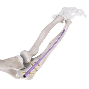 Conventus Flower Orthopedics Announces Expansion of its Flex-Thread™ Technology Platform with FDA Clearance of the Ulna Intramedullary Nail System