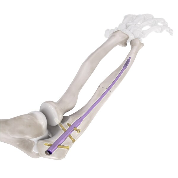 Flex-Thread™ Ulna Intramedullary Nail System