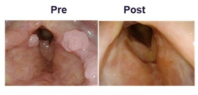 FIGURE 1: Patient Papilloma Growth at Baseline (Pre-Treatment) and 24-weeks Post-Treatment with PRGN-2012