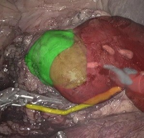 An overlay image of relevant organs and structures overlaid on a real-time video stream during surgery (RSIP Neph)