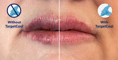 Post lip filler with and without use of TargetCool