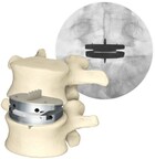 Aetna® Updates Disc Replacement Guidelines; All Major Payors Now Cover Centinel Spine's Lumbar Total Disc Replacement
