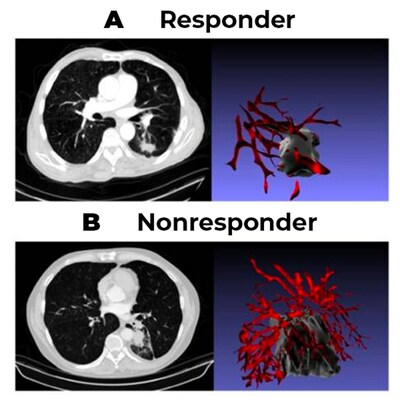 The blood vessels feeding tumors which respond to cancer treatment are less twisted and more organized (A) compared to those surrounding  tumors which do not respond to treatment (B).