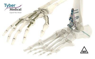 Tyber Medical’s latest 510(k) FDA clearance covers a line extension to its Anatomical Plating System that features 391 additional plate configurations, including 100 new plates targeting foot, ankle, hand and wrist indications.