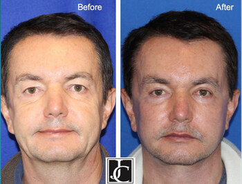 Dr Jay Calvert Details the Natural Lift™ Facelift