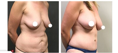 A before and after fat transfer breast augmentation by Dr. Javad Sajan.