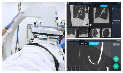 (Left: LungVision™ case using GE Healthcare OEC C-arm. Upper right: LungVision™ AI Tomography intraoperative CT scans showing tool-in-lesion confirmation. Lower right: LungVision™ 3D View providing an interactive 3D render of tool-in-lesion.)