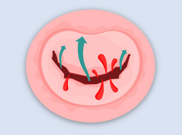 HeartValveSurgery.com, Cedars-Sinai and Penn Medicine Launch Mitral Valve Disease Awareness Week to Educate Heart Patients About Health Risks & Treatment Advances - Vimarsana News