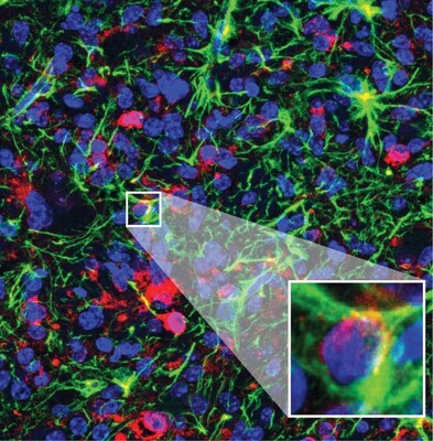 Here we see a close-up of DIPG tumor cells transforming into healthy cells after treatment with the Krainer lab’s new potential ASO drug. Professor Krainer is the deputy director of research at the CSHL Cancer Center.