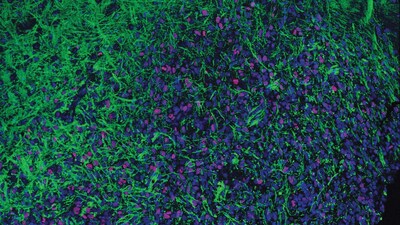 Cold Spring Harbor Laboratory Professor Adrian Krainer developed several antisense oligonucleotide (ASO) molecules for a new potential cancer treatment, but the most potent was ASO5. When mice were treated with ASO5, their tumor cells (stained red) grew slower and began differentiating into healthy cells (stained green).