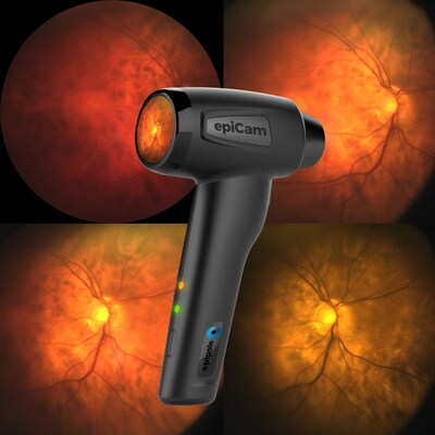 epiCam handheld retinol imaging
