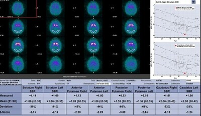 Figure 2b - DatQUANT showing symmetric abnormal striatal binding ratios with Z scores of more than 2SD below the mean confirming the visually abnormal DaTscan and consistent with abnormal FDG PET-CT scan diagnosis of DLB. Abnormal striatal binding ratios help confirm the visually abnormal diagnosis. (PRNewsfoto/SimonMed Imaging)