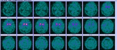 Figure 2a - DaTscan image showing symmetrically reduced Ioflupane 123 uptake bilaterally demonstrating an abnormal pattern of DaTscan uptake. (PRNewsfoto/SimonMed Imaging)