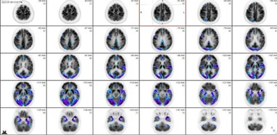 Figure 1 - FDG PET-CT scan in patient with Dementia with Lewy Bodies (DLB). Abnormal hypometabolism within the bilateral occipital lobes highlighted with purple color. (PRNewsfoto/SimonMed Imaging)