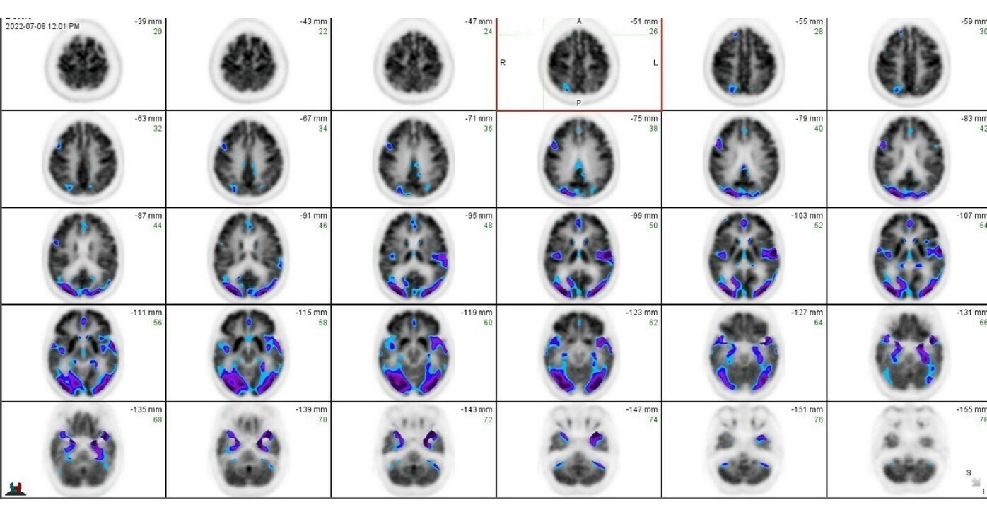 SimonMed Announces Offering of DaTscan