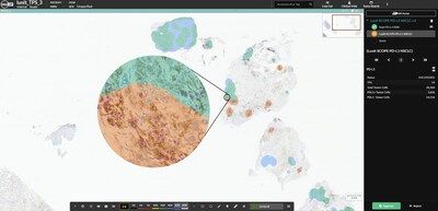 An example of the Lunit SCOPE PD-L1 NSCLC markup image in HALO AP. The cyan, blue and orange masks reflect the local tumor proportion score (TPS). Positive cells are shown in purple while negative cells are shown in cyan. The overall TPS is reported at the right.