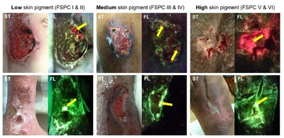 Sequence of standard (ST) and fluorescence (FL) images acquired by the MolecuLight imaging device of wounds with troublesome bacterial burden in patients with different skin tones. The yellow arrows indicate areas of high bacterial presence (red) and the presence of pseudomonas aeruginosa (cyan).