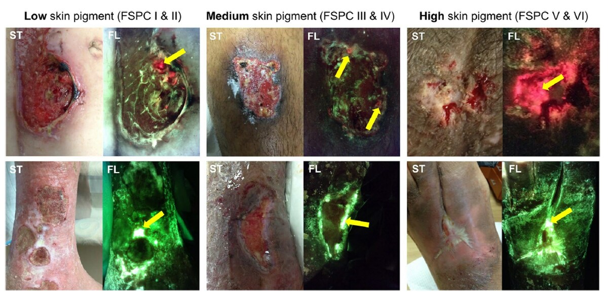 New Publication Reveals MolecuLight Imaging Significantly Improved Detection of Bacterial Burden Across Patients of All Skin Tones - Vimarsana News