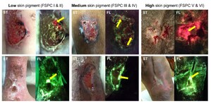 New Publication Reveals MolecuLight Imaging Significantly Improved Detection of Bacterial Burden Across Patients of All Skin Tones