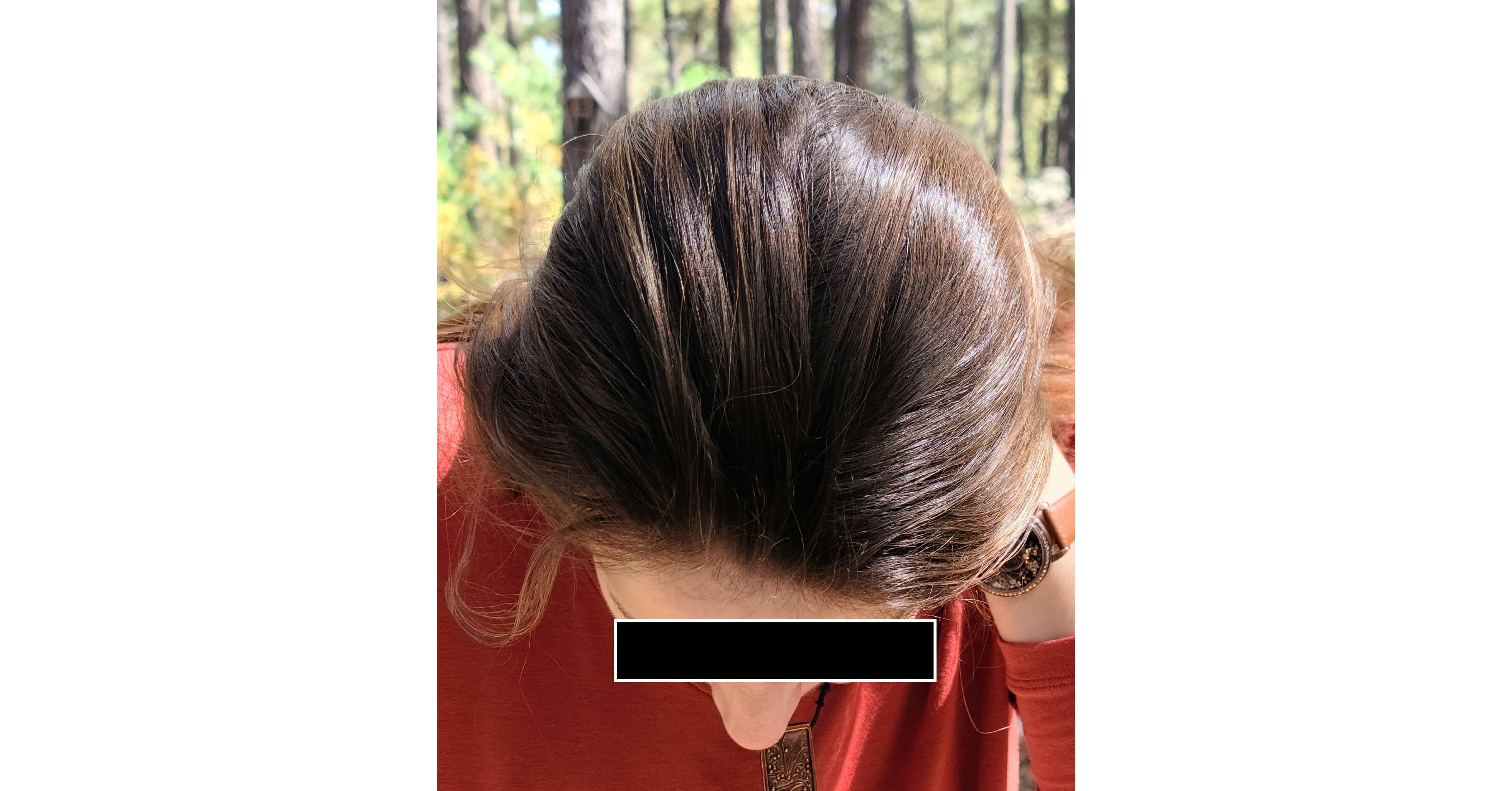 Cancer Centers Rush to Adopt Cooler Heads' Scalp Cooling System to Meet