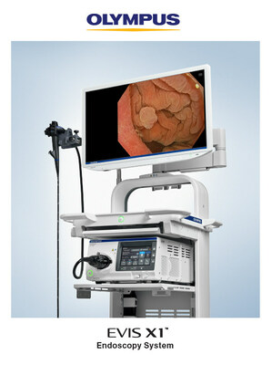 The Olympus EVIS X1tm endoscopy system offers physicians new ways to view gastrointestinal anatomy for the purpose of diagnosing, treating, and observing GI diseases and disorders.