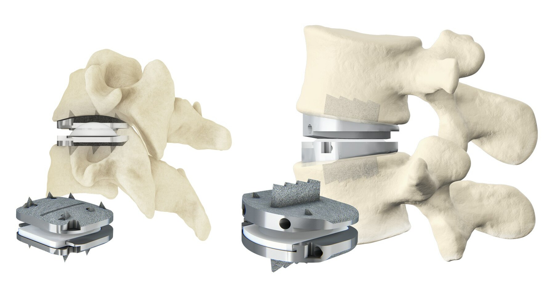 Centinel Spine® prodisc® Nominated for 