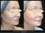 WellMedica Cosmetic Laser Surgery Center Introduces New UltraClear Cold Fiber Laser for Age-Reversing Treatments