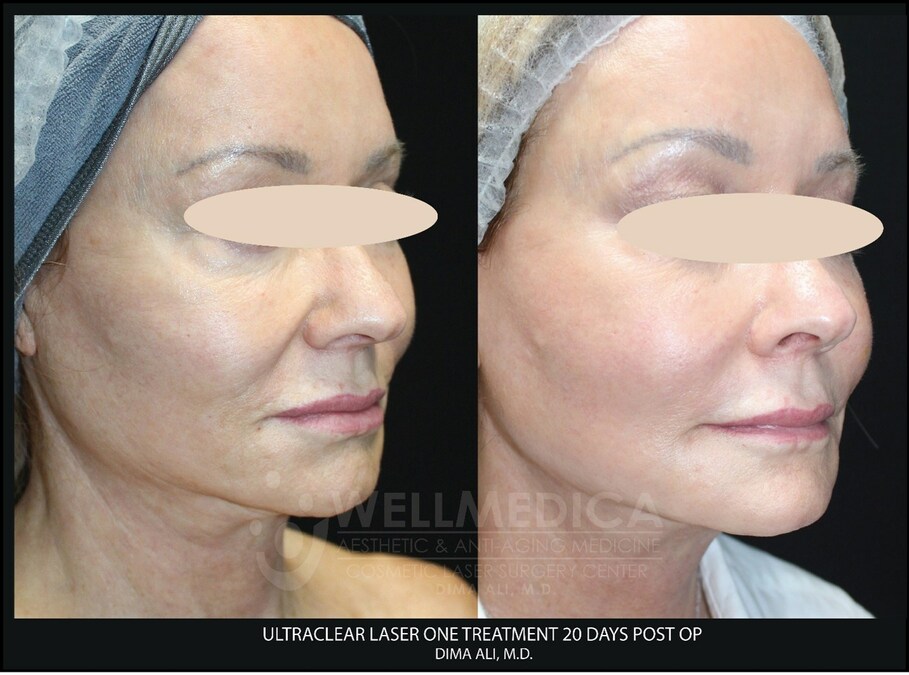 WellMedica Cosmetic Laser Surgery Center Introduces New UltraClear Cold Fiber Laser for Age-Reversing Treatments - Vimarsana News