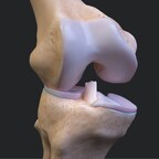 Arthrex Launches Patient Education Website for ACL Injuries