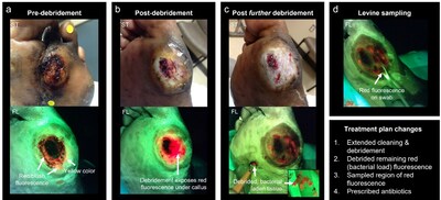 Fluorescence-informed treatment plan changes using MolecuLight imaging for a stalled diabetic foot ulcer (DFU) exhibiting delayed healing but no signs or symptoms of infection 