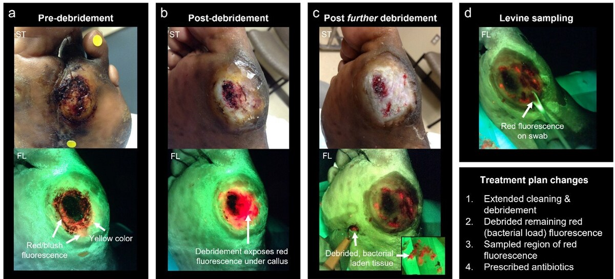 Largest Published Real-World Wound Imaging Study Reports MolecuLight® led to Wound Treatment Plan Changes in up to 53% Cases - Vimarsana News