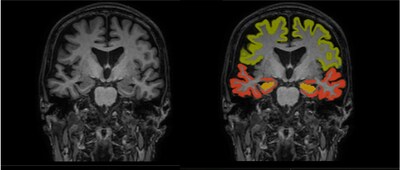 Dementia MRI with segmentation