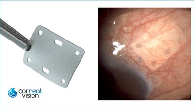 Left – CorNeat EverPatch; right – CorNeat EverPatch implanted under the conjunctiva, 9 months post implantation