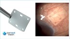 La FDA approuve CorNeat EverPatch, le premier substitut tissulaire synthétique non dégradable pour la chirurgie ophtalmique