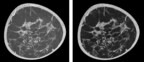 AI Advances in Healthcare: Koning Corporation Unveils Revolutionary AI-Enhanced Software to Boost Breast CT Image Quality