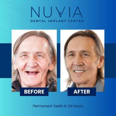 Before and After Permanent Teeth in 24 Hours from NUVIA Dental Implants Center.