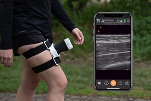 Clarius and Usono Announce an International Agreement to Bring Wireless and Wearable Ultrasound Imaging to Researchers