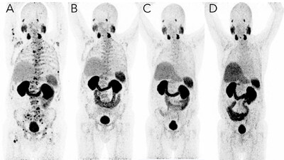 A 73-year-old male with mCRPC in 2017 with multiple bone and lymph node metastases with increased PSMA expression. PSMA imaging before and after targeted radioligand therapy with Lu–PSMA-617.