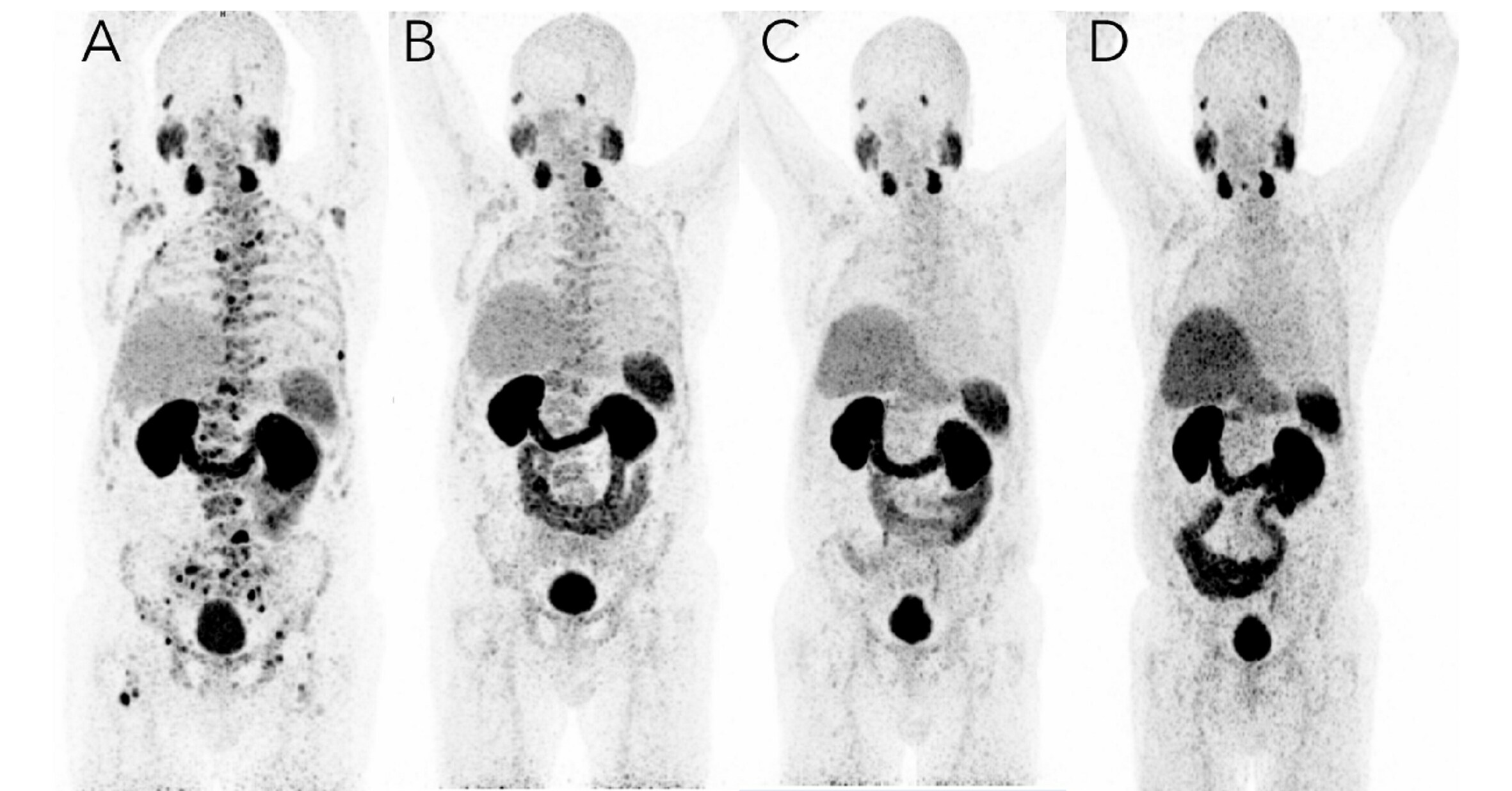 innovative-treatment-for-prostate-cancer-shows-long-term-success