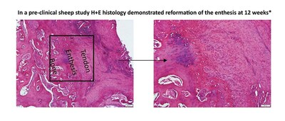 Reformation of the enthesis