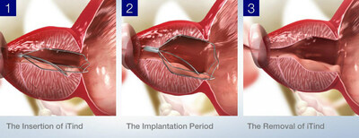 The iTindtm procedure involves the placement of a temporarily implanted nitinol device that reshapes the prostatic urethra without burning or cutting out the prostate. The device remains in place for five to seven days, and upon removal, patients experience rapid and effective relief of their benign prostatic hyperplasia (BPH) symptoms.